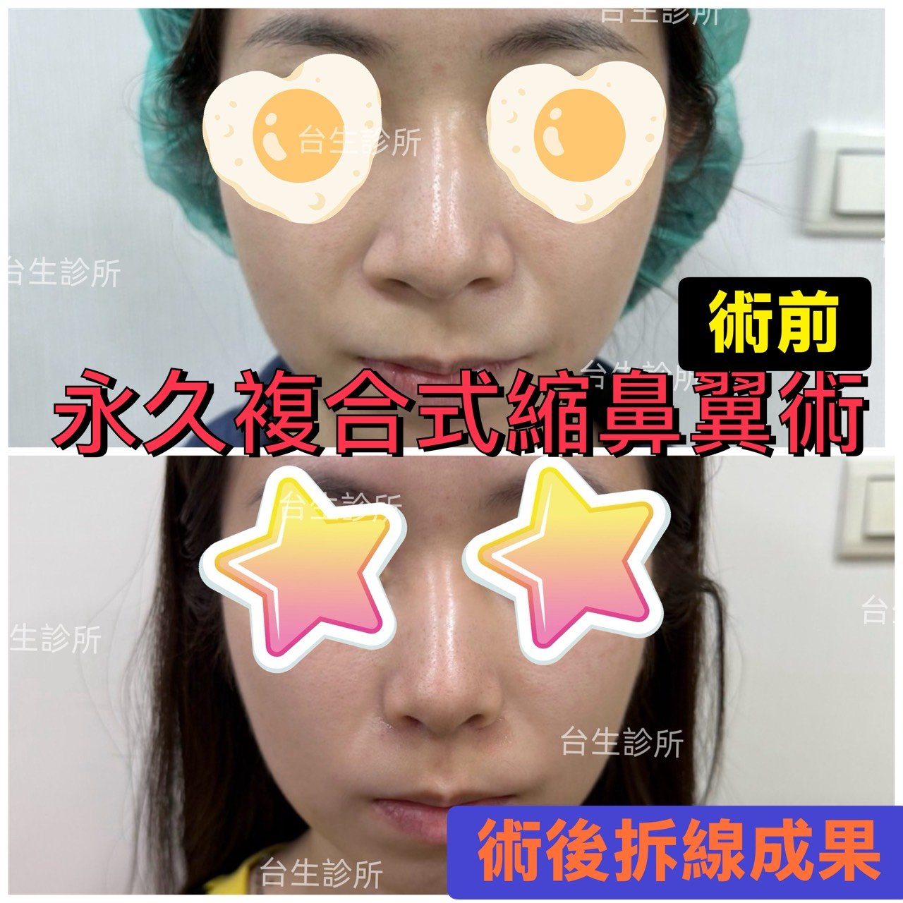30分鐘微創永久縮鼻翼術後拆線結果 - 