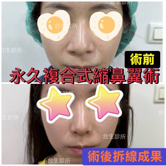 30分鐘微創永久縮鼻翼術後拆線結果 - 