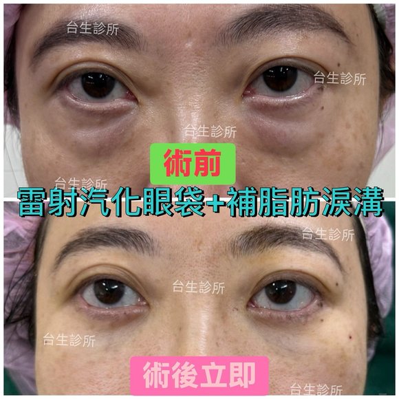 30分鐘雷射汽化眼袋+自體脂肪填補淚溝~術後效果呈現 -