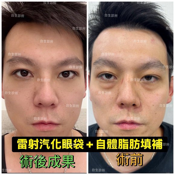 30分鐘雷射汽化眼袋+自體脂肪填補淚溝~術後效果呈現 - 