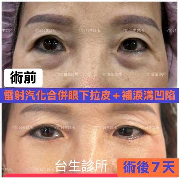 雷射汽化合併眼下拉皮+補淚溝凹陷 - 
