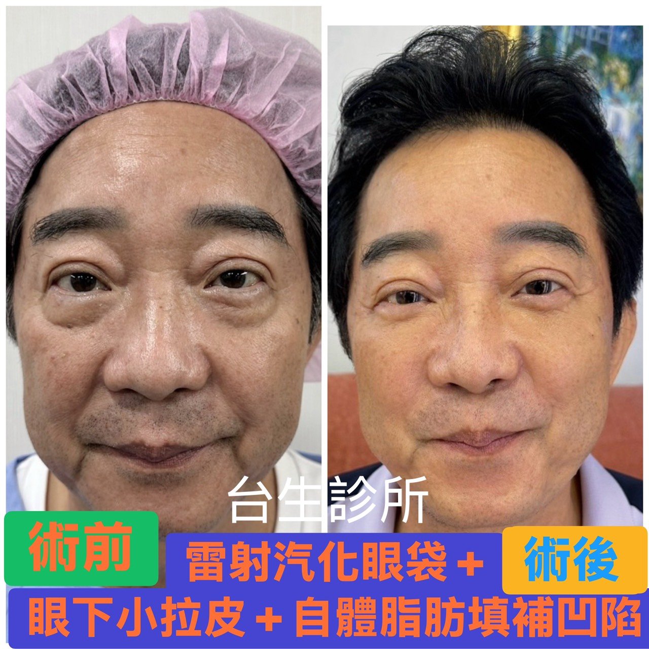 [內有影片~天天開心~知名演藝人員]~術後7天~30分鐘雷射汽化眼袋合併眼下小拉皮+自體脂肪填補 - 