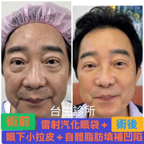 [內有影片~天天開心~知名演藝人員]~術後7天~30分鐘雷射汽化眼袋合併眼下小拉皮+自體脂肪填補 - 