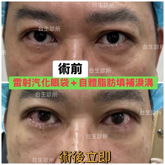 術後立即效果~30分鐘雷射汽化眼袋+自體脂肪填補淚溝 - 