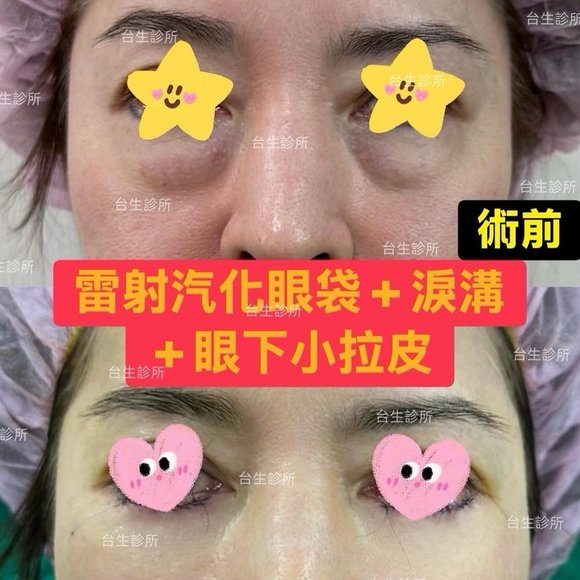 30分鐘雷射汽化眼袋+淚溝補脂肪+眼下小拉皮 - 