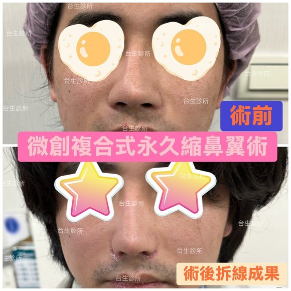 擺脫大笑外擴感~ 30分鐘微創永久精緻縮鼻翼術 - 