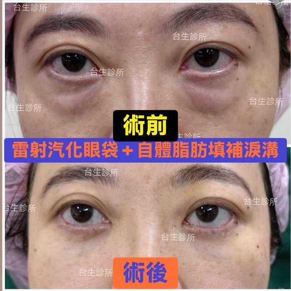 30分鐘雷射汽化眼袋+自體脂肪填補淚溝~術後效果呈現 - 