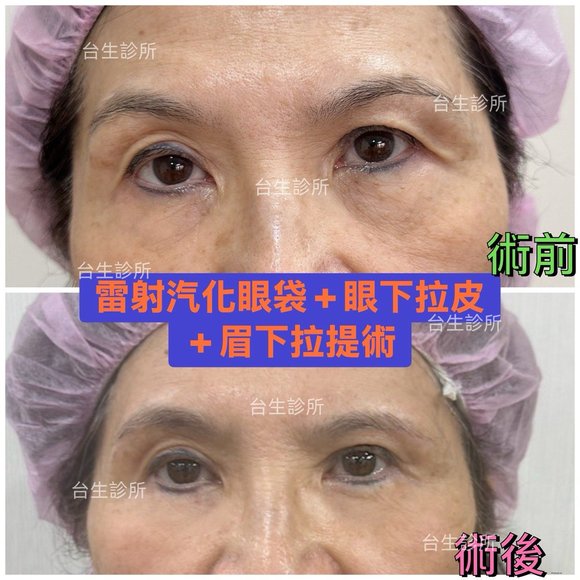30分鐘雷射汽化眼袋+眼下拉皮+眉下拉提術 - 