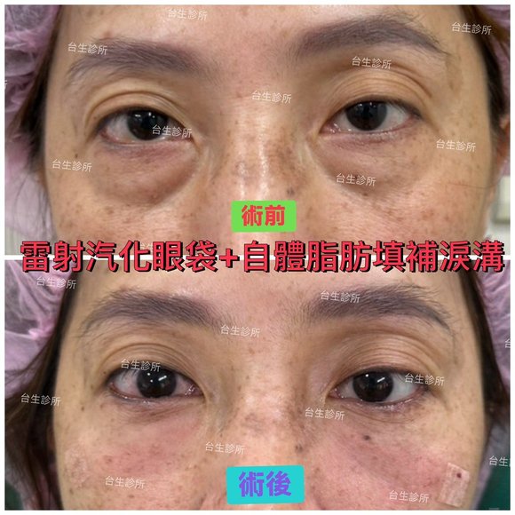 術後立即效果~30分鐘雷射汽化眼袋+自體脂肪填補淚溝 - 