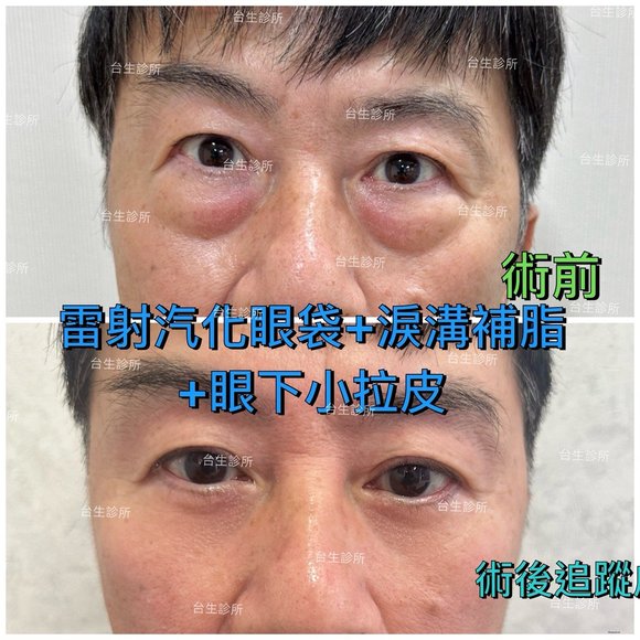 術後追蹤~30分鐘雷射汽化眼袋+淚溝補脂肪+眼下小拉皮 - 