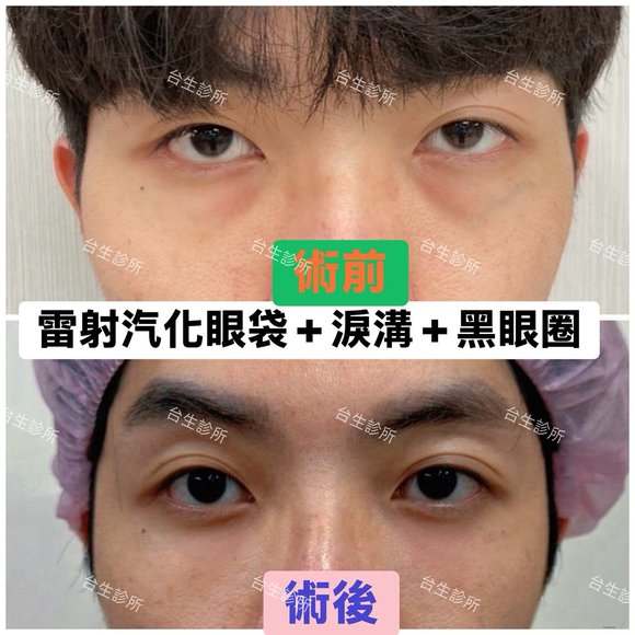 術後成果~30分鐘雷射汽化眼袋+自體脂肪填補淚溝黑眼圈 - 