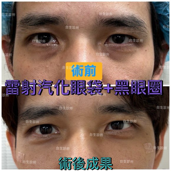 術後成果~30分鐘雷射汽化眼袋+自體脂肪填補淚溝黑眼圈 - 
