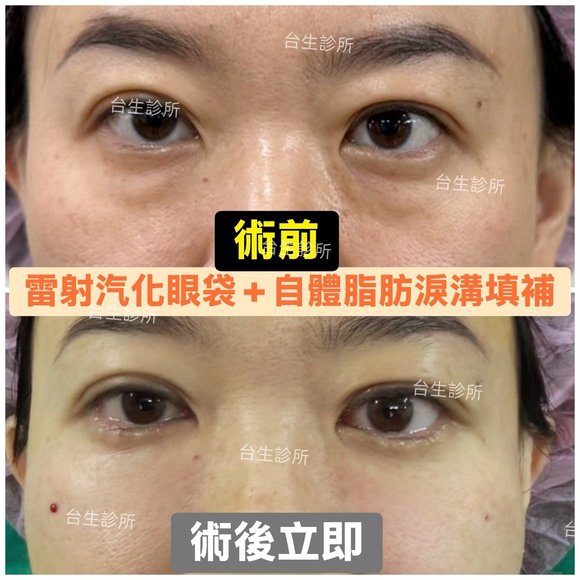 術後立即效果~30分鐘雷射汽化眼袋+自體脂肪填補淚溝 - 