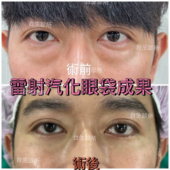 30分鐘無痛雷射汽化眼袋術後效果 - 