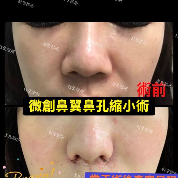 當天術後真實呈現~ 30分鐘微創永久精緻縮鼻翼術 - 