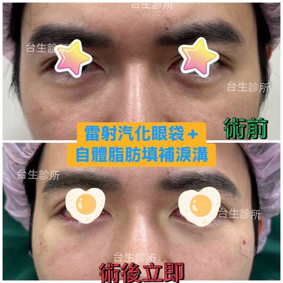 術後立即效果~30分鐘雷射汽化眼袋+自體脂肪填補淚溝 - 