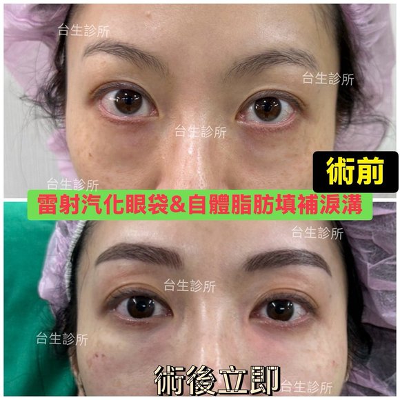 術後立即效果~30分鐘雷射汽化眼袋+自體脂肪填補淚溝 - 