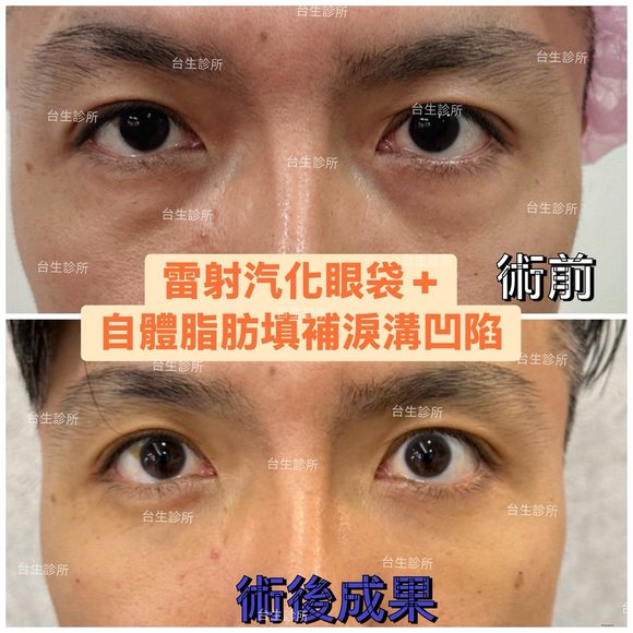 30分鐘雷射汽化眼袋+自體脂肪填補淚溝~術後效果呈現 - 