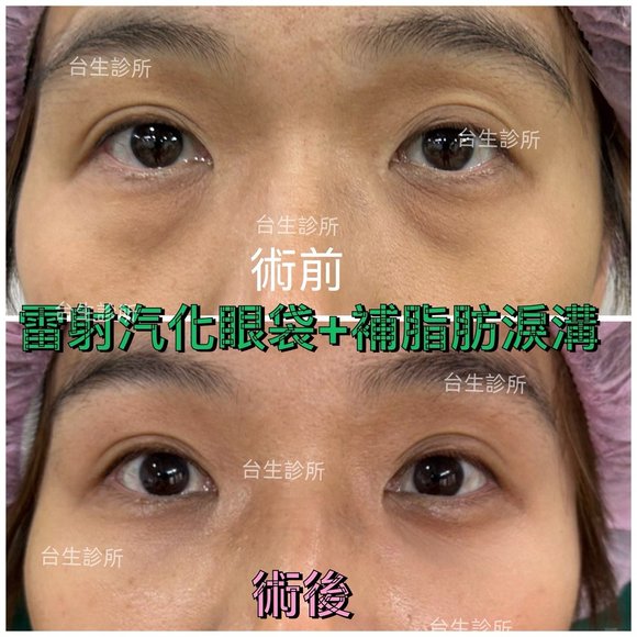 術後成果~30分鐘雷射汽化眼袋+自體脂肪填補淚溝黑眼圈 - 