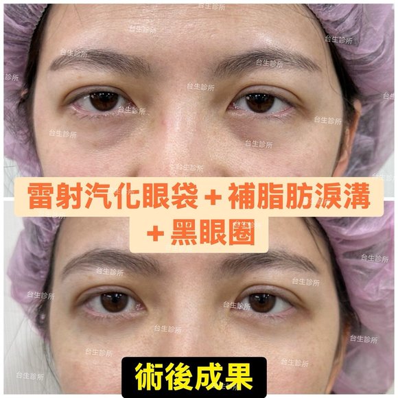 術後成果~30分鐘雷射汽化眼袋+自體脂肪填補淚溝黑眼圈 - 