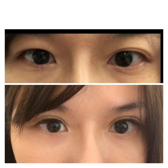 縫合式雙眼皮 - 