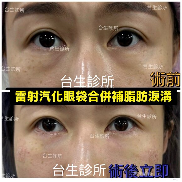 術後立即效果~30分鐘雷射汽化眼袋+自體脂肪填補淚溝 - 