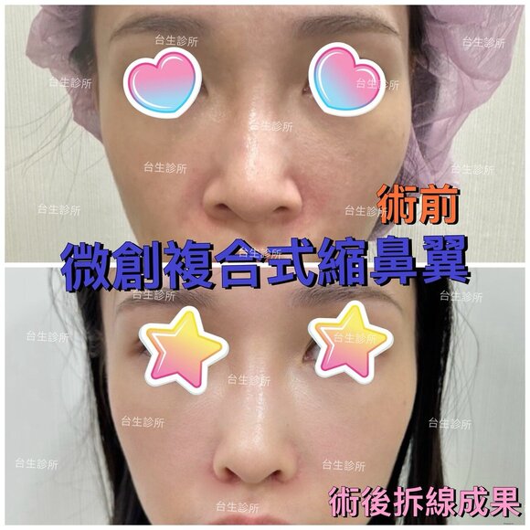 擺脫大笑外擴感~ 30分鐘微創永久精緻縮鼻翼術 - 