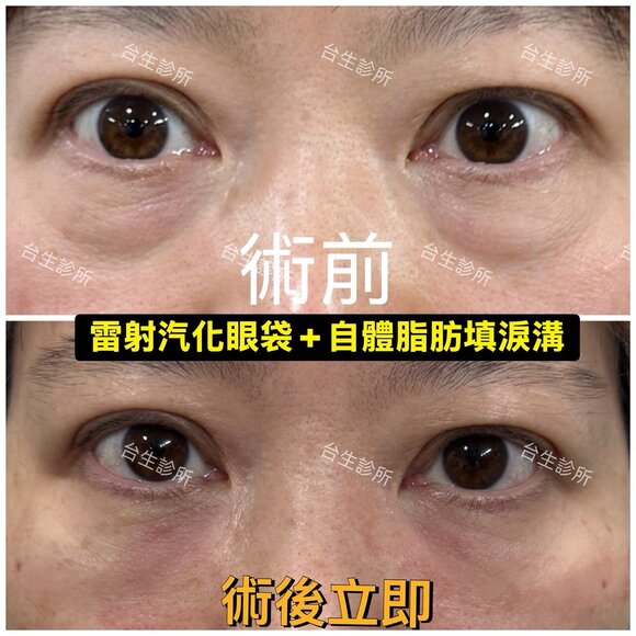 術後立即效果~30分鐘雷射汽化眼袋+自體脂肪填補淚溝 - 