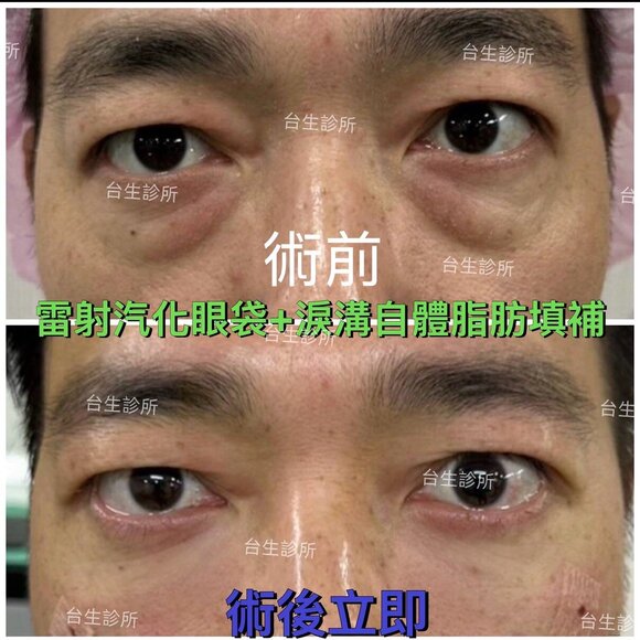 恢復年輕擺脫老態~30分鐘雷射汽化眼袋+3D自體脂肪填補淚溝黑眼圈 - 