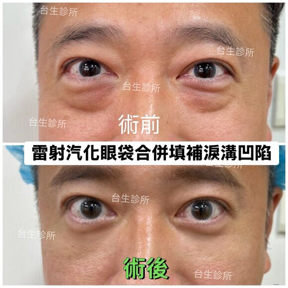 大眼蛙去除~30分鐘雷射汽化眼袋+3D自體脂肪填補淚溝黑眼圈 - 