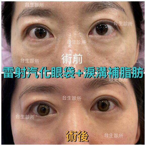 術後成果~30分鐘雷射汽化眼袋+自體脂肪填補淚溝黑眼圈 - 