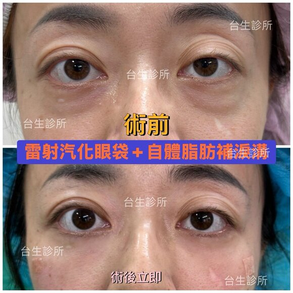 術後立即效果~30分鐘雷射汽化眼袋+自體脂肪填補淚溝 - 