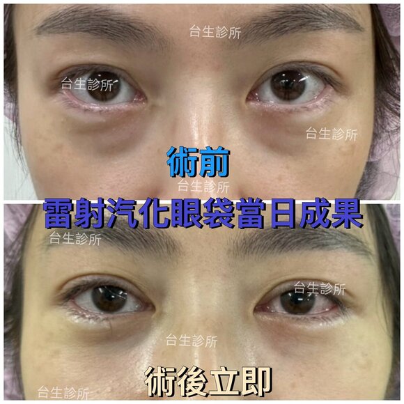 術後立即效果~30分鐘無痛雷射汽化眼袋術 - 