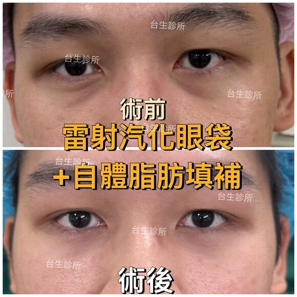 術後成果~30分鐘雷射汽化眼袋+自體脂肪填補淚溝黑眼圈 - 