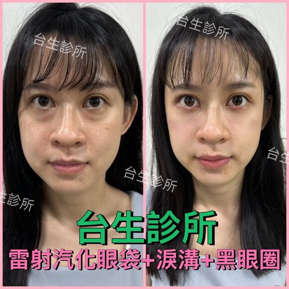 [內有影片] 30分鐘雷射汽化眼袋+自體脂肪填補淚溝~術後效果呈現 - 