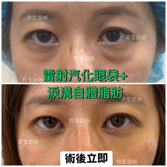 術後立即效果~30分鐘雷射汽化眼袋+自體脂肪填補淚溝 - 