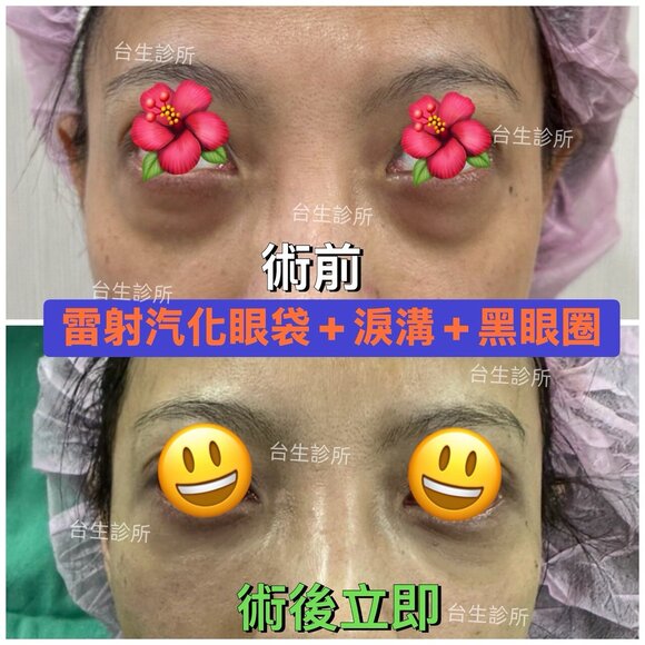 術後立即成果~30分鐘雷射汽化眼袋+自體脂肪填補淚溝黑眼圈 - 