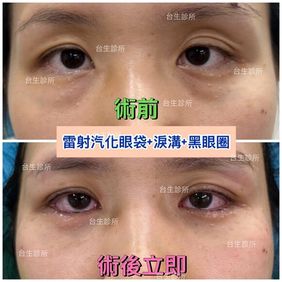 術後立即成果~30分鐘雷射汽化眼袋+自體脂肪填補淚溝黑眼圈 - 