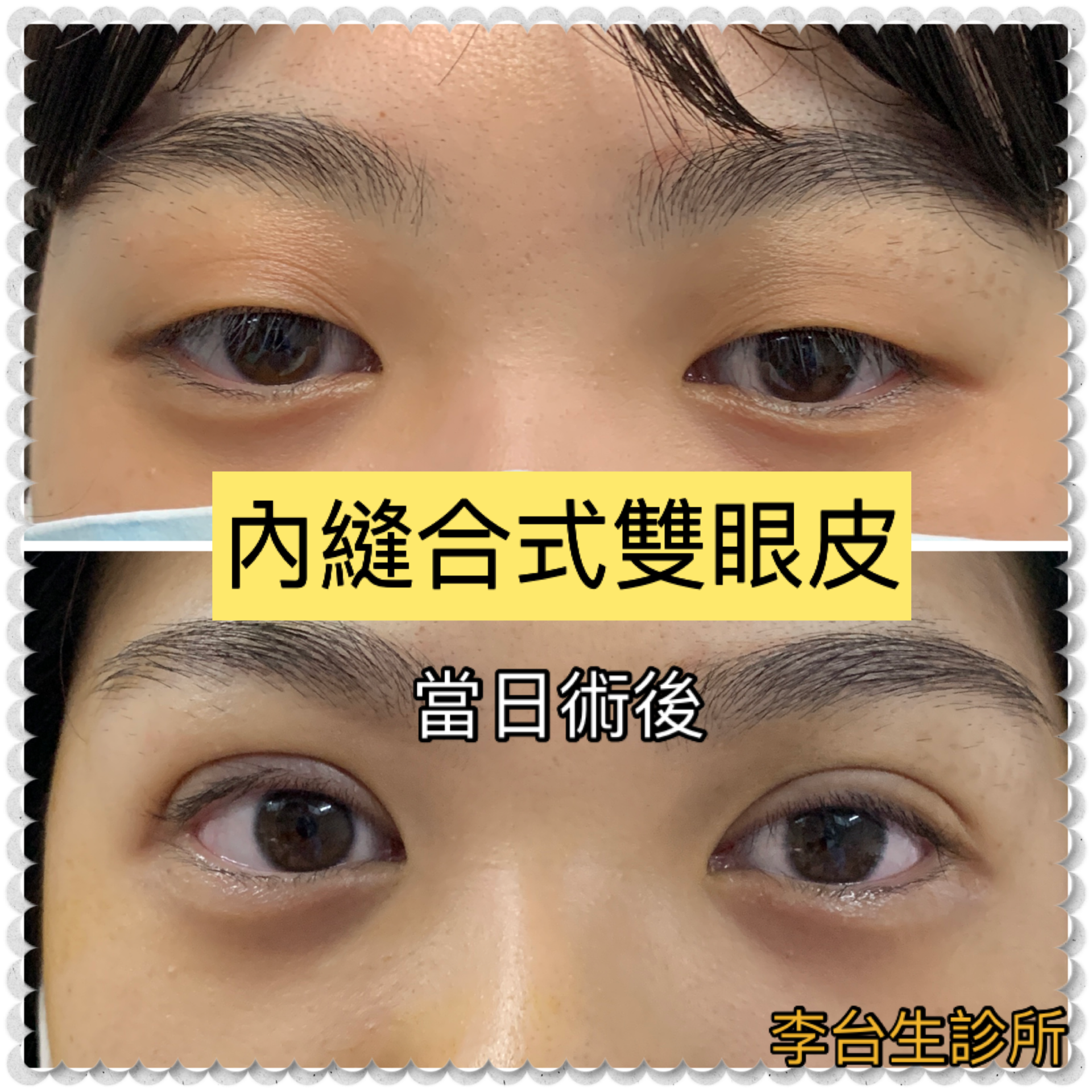 縫合式雙眼皮 - 