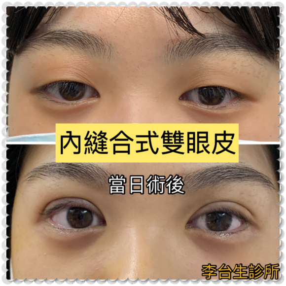 縫合式雙眼皮 -