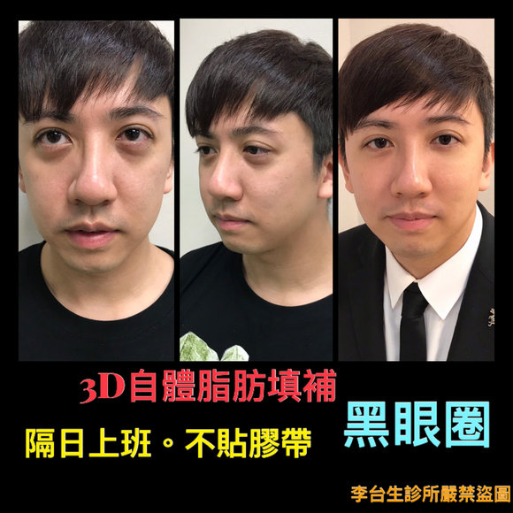 3D自體脂肪填補 -