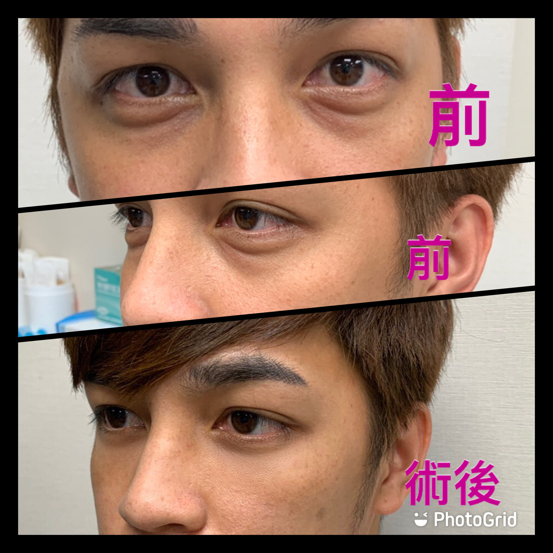 3D自體脂肪填補 - 