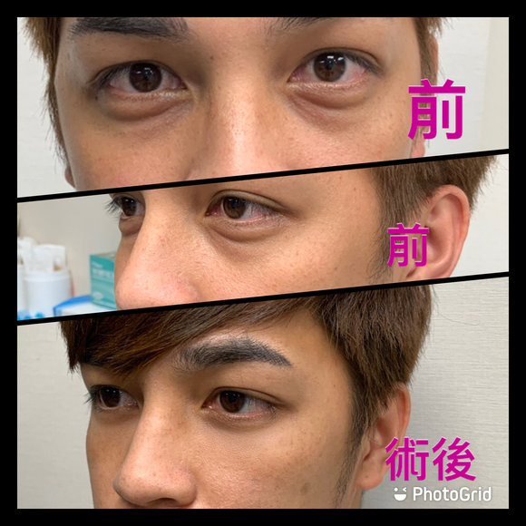 3D自體脂肪填補 -