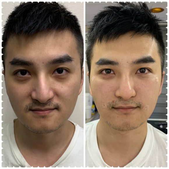3D自體脂肪填補 - 