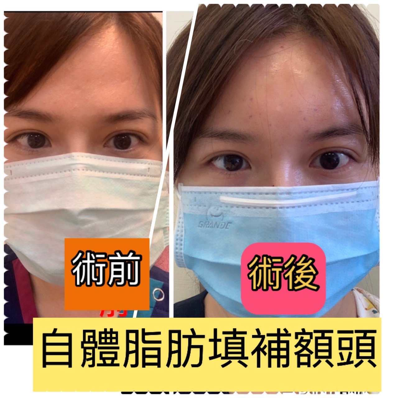 3D自體脂肪填補 - 