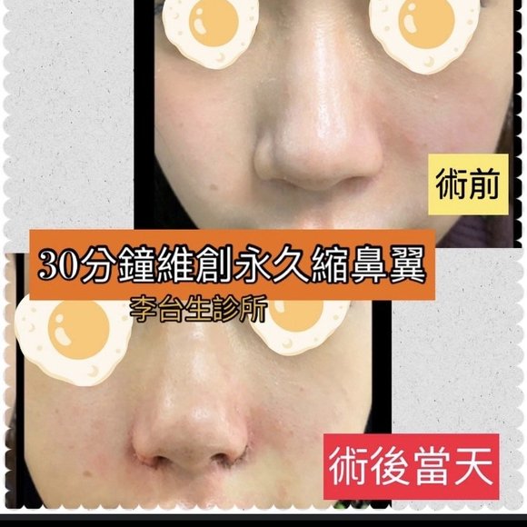 微創縮鼻翼 -