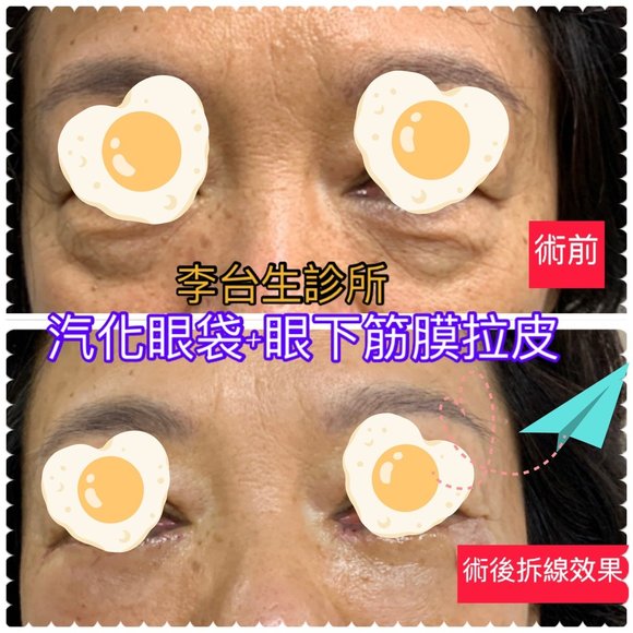 汽化眼袋合併眼下筋膜拉皮 - 