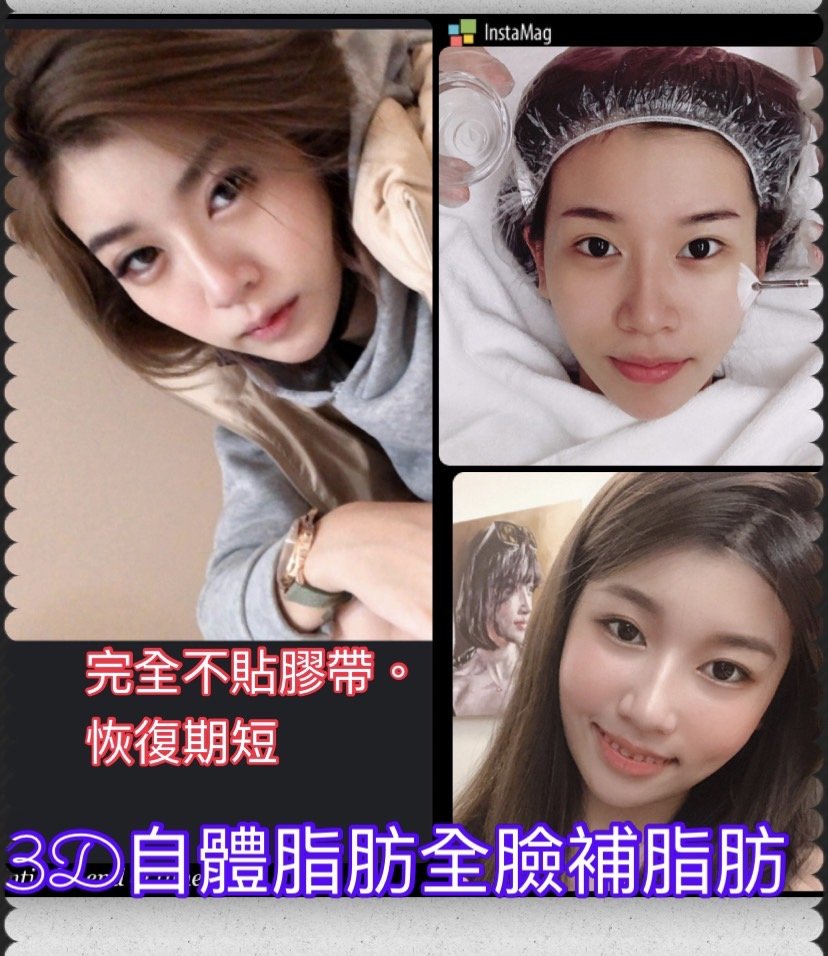3D自體脂肪填補 - 