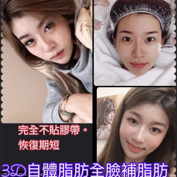 3D自體脂肪填補 - 