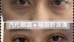 解除眼袋吸毒感 - 解除眼袋吸毒感,30分鐘雷射汽化眼袋手術。擺脫傳統內外開、不用貼膠帶、不用拆線!術後照顧好輕鬆,完整取出眼袋脂肪,配合高層次萃取脂肪技術移植淚溝!實際突破3萬人次成功案例。